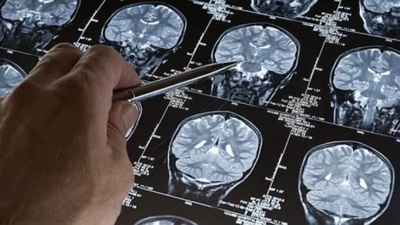 Buscan revelar la "firma molecular" del Alzheimer