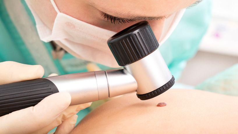 Signos para descubrir tu riesgo de cáncer de piel