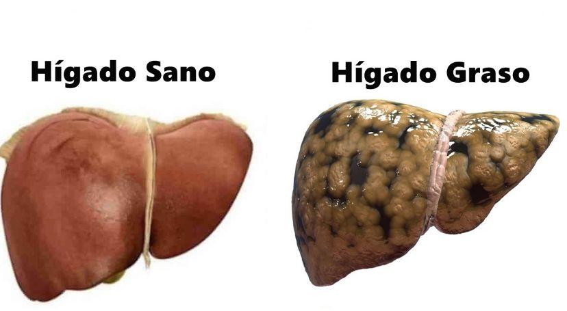 Dieta para el higado graso no alcoholico